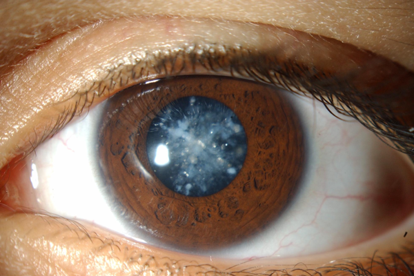 cataract